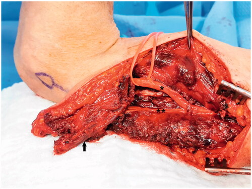 Figure 3. Reverse lateral arm flap pedicle dissection (Arrow) and sparing of the radial nerve (*) and posterior cutaneous nerve of the arm (**).