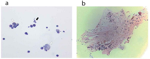 Figure 3. Histopathology. (a) Cytology from bronchoalveolar lavage fluid of case 1. The hollow arrows point to few non-vacuolated foamy macrophages, without droplet deposition. The black arrow points to one bronchial cell. (b) Pathology from lung biopsy of case 1. Minimal tissue. There is no alveolar damage observed