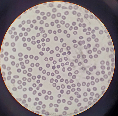Figure 1 Peripheral blood smear with normal RBC morphology and absent platelets.