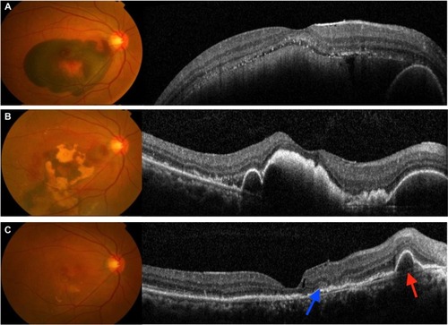 Figure 6 Submacular hemorrhage in neovascular AMD.