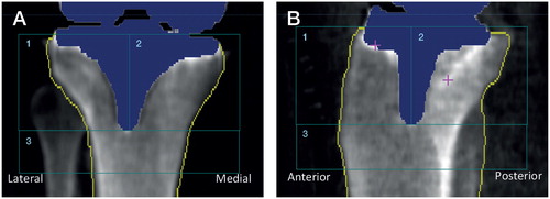 Figure 3. DXA scans showing the implant detection of the finned stemmed implant (blue), bone borders (yellow line), and 3 regions of interest (ROI) around the stem. A. Anterior/posterior view. B. Lateral view.