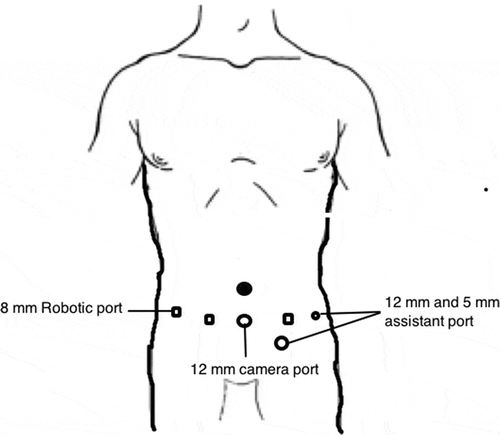 Figure 2. Port placement for left-sided IVCT.