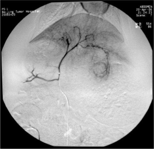Figure 3 Angiography of the hepatic artery proper shows a clear rich blood supply to the tumor, especially at the rim.