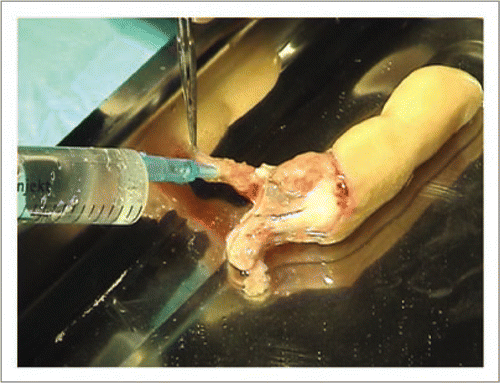 Figure 6 The dominant collateral artery was again catheterized and the finger abundantly rinsed with physiological serum until tissues recovered a normal consistency. Heparin was administered intravascularly to avoid non-reflow phenomenon.