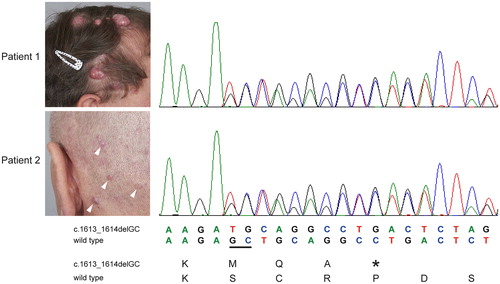 Figure 1. Nucleotide sequence analysis showing a germline two base monoallelic deletion in CYLD exon 11 in two brothers presenting with multiple cutaneous cylindromas on the scalp (white arrowheads). The asterisk indicates a STOP codon predicted to terminate translation. Nucleotides deleted in the wild-type allele are underlined.
