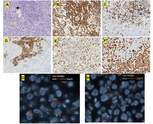 Figure 3 The core needle biopsy of the pelvic mass showed a diffusely infiltrating large atypical cells (yellow arrow) with intermixed clusters of small lymphocytes (black arrow) (A, H&E x 20). Immunohistochemical studies showed both small and large lymphocytes were strongly positive for CD20 (B, x 20). While the small lymphocytes showed aberrant expression of CD5 (C, x 20) and CD23 (D, x 20), the large lymphocytes were negative for CD5 and CD23 but positive for BCL6 (E, x 20) with a high proliferative rate by ki-67 (F x 20). FISH analysis with break-apart probes demonstrated MYC gene rearrangement (G, arrows indicate separation of 5ʹMYC and 3ʹMYC) and BCL6 gene rearrangement (H, arrows indicate separation of 3ʹBCL6 and 5ʹBCL6), which confirmed the diagnosis of “double-hit” large cell lymphoma.
