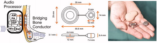 Figure 2. The BCI system (left) consists of an external audio processor which includes a digital sound processor (DSP) that drives a power amplifier (PA) and an amplitude modulation (AM) induction link connected to the transducer secured in a recess of the mastoid portion of the temporal bone. The audio processor is held in place by magnets (N and S poles) over the implanted unit called the Bridging Bone Conductor. Sizes of the Bridging Bone Conductor are shown in the middle and the real appearance, including the audio processor to the right.