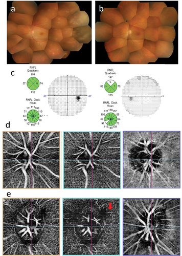 Figure 2. Case 2: Acute retinal necrosis in the left eye. (a) Fundus image of the left eye at presentation. Vitreous opacification and obstructive phlebitis are observed. A yellowish white lesion with fusion expansion is visible in peripheral retina. The optic disc appears normal. (b) Fundus image of the left eye at 3 months after treatment. Vitreous opacification and obstructive phlebitis have improved. The yellowish white lesion has disappeared completely. (c) Optic nerve head analysis by OCT and visual field examination by HFA at 8 months after treatment. show no remarkable abnormalities in both examinations. (d) and (e) OCTA examination of the optic nerve at 8 months after treatment. OCTA images of the optic nerve head, radial peripapillary capillaris (RPC), and choroid are shown sequentially from the left. (d) No abnormalities are observed in the unaffected right eye. (e) in the left eye, looped capillary network is observed in RPC (red arrow).