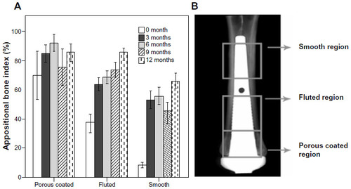 Figure 5 (A) ABI values at the time of the surgery (time 0) and at 3, 6, 9, and 12 months postsurgery. Data was obtained from a translational animal model, where sheep were implanted with a percutaneous OI implant in their fused right metacarpal III, IV bone. Statistically significant differences were found, between time 0 and all other time points, of fluted and smooth regions. (B) A radiographic image of the intramedullary implant, schematically showing the regions used for the ABI measurements.
