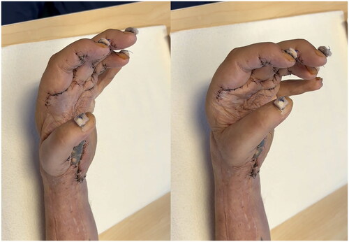 Figure 5. (A) 11-month follow-up in extension and (B) flexion.