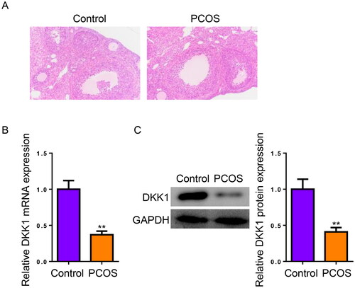 Figure 1. DKK1 is downregulated in PCOS. (A) for Comparison of rat ovarian structure from Control (n = 6) and PCOS (n = 6) groups by H&E staining. (B and C) DKK1 mRNA and protein expression in ovaries from Control and PCOS rats by RT-qPCR and Western blotting. *p < .05; **p < .01.