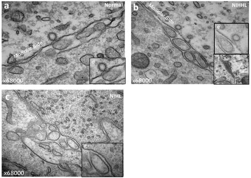 Figure 4. TEM images of Low-SR ribbon synapses in genuine pigs one month after noise exposure. Compared with normal group (a), ribbon synapses in NIHHL group showed different degrees of impairment (b). Some ribbon synapses are still normal (e) and some are obviously damaged (f). In the NIHL group, the pre-synaptic ribbon structures were disappeared (c). NIHL: noise induced hearing loss group; NIHHL: noise induced hidden hearing loss group; Normal: normal group.