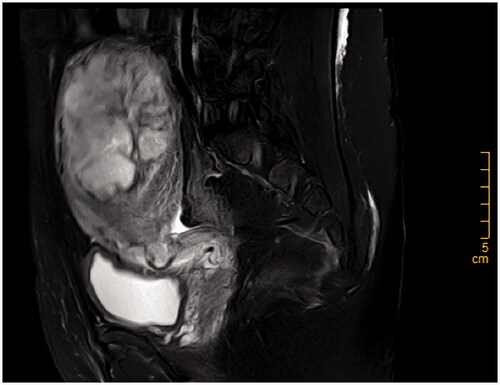 Figure 1. T2-weighted imaging of sagittal view showing part of the placenta that had invaded the wall of the uterus.