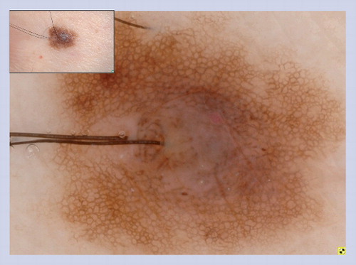 Figure 4. Congenital melanocytic nevus of the lower extremity.A reticular pattern is seen and the network is interrupted by follicular openings (hypertrichosis). Perifollicular hypopigmentation is a common feature seen in congenital melanocytic nevus.