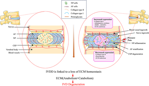 Figure 1 A diagram showing healthy IVD and the key pathogenic and anatomical alterations in IVDD. MMPs is Matrix metalloproteinases, ADAMTS is Metalloproteinase with Thrombospondin Motif.