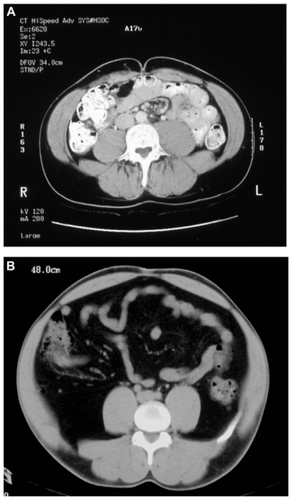 Figure 1 Computerized tomography scans of (A) a healthy adult and (B) a patient with coexisting lipoatrophy and lipohypertrophy. In comparison with the healthy adult, the patient with coexisting lipoatrophy and lipohypertrophy has less subcutaneous adipose tissue and an increase in intra-abdominal (visceral) adipose tissue.