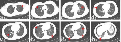 Figure 3 In March 2015, CT images collected after denosumab treatment for 13 months.Notes: The nodule remained stable in size (a3); the nodule remained stable with size 0.6 cm in diameter (b3); the diameter of the nodule decreased to 0.8 cm (c3); one nodule disappeared on the right side (d3); there was no change in the size of the nodule (e3); the one on the left side reduced to 1.0 cm in diameter (f3); the two nodules reduced to 0.8 and 0.6 cm in diameter, respectively (g3); the nodule reduced to 1.2 cm in diameter (h3). Arrows point to the nodules.Abbreviation: CT, computerized tomography.