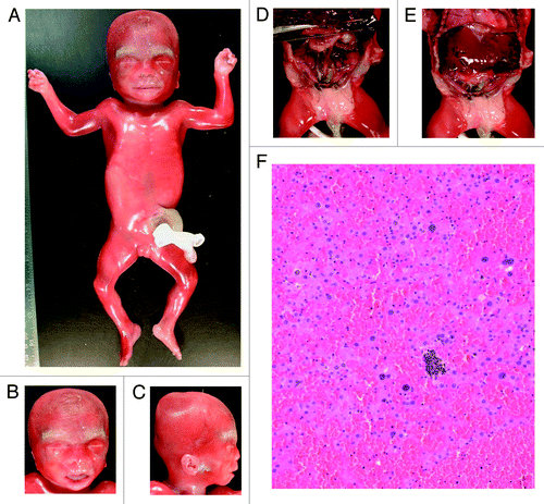Figure 3. Autopsy of prenatal case F1. Hypertrophy of the labia majora (A), macroglossia (B), ear anomalies (C), visceromegaly with hepatomegaly, nephromegaly, and ovarian hypertrophy (D and E), and adrenocortical cytomegaly (F).