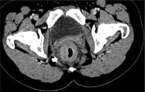 Figure 3 Computed tomography scan of 29-year-old woman with signet-ring cell carcinoma of the rectum.