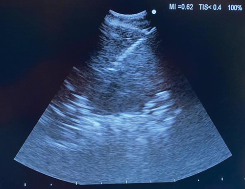 Figure 7. EUS-B image of a lung tumor in the left upper lobe being biopsied.