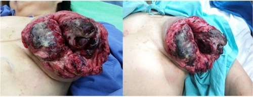 Figure 1 Tumor of entire left breast (rupture size 22×18 cm).
