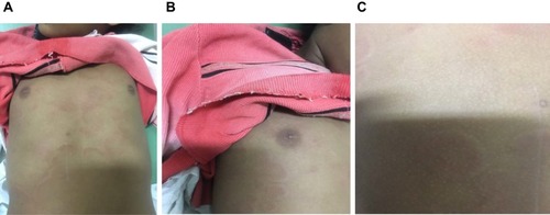 Figure 1 Circular raised peripheral erythematous lesion over the anterior trunk with central clearing. (A) Multiple annular skin lesions with erythmatous, raised border central LT clearing located at the anterior trunk. B and C are close-up views.