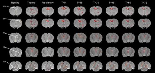 Figure 2 Effects of thermal noxious stimulation and sciatic denervation on the supraspinal representation of pain. False -color images of changes in BOLD signal presented in coronal slices showing the ACC, S1, Th, IC and VTA during a resting state (Resting), thermonociception (Thermo), immediately prior to sciatic denervation (Pre-denerv), during denervation (T=0) and during post denervation acquired every 15 minutes (t = 15, 30, 45, 60 and 75). T-maps are overlaid to the corresponding T1-weighted structural images for each subject. A representative subject for each of the structures is presented in each row. Note the increase in BOLD activity by thermonociceptive stimulation of the left paw in the ROIs of all structures compared to the resting state. As well as the increase in BOLD activity from sciatic denervation and throughout 75 min.