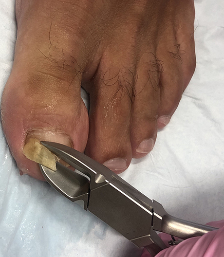 Figure 3 A nail clipper is used to clip the most proximal area of onycholysis.