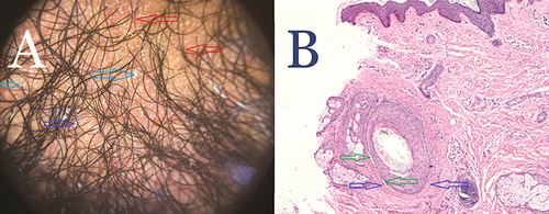 Figure 5 (A) Trichoscopy of normal-appearing beard area of a patient with AKN showing perifollicular and interfollicular erythema Red arrows) and scales (Blue arrows). (B) Hematoxylin and eosin staining of trichoscopy guided-normal appearing in the beard area of a patient with AKN showing PIILIF. A horizontally sectioned follicle with a scant lichenoid inflammatory cell infiltrate composed of lymphocytes and plasma cells, effacing the dermal-epidermal junction associated with perifollicular fibrosis (Blue arrows). Premature desquamation associated with a Max-Josef space (Green arrow) is visible. No Vellus or miniaturized hairs or sebaceous glands are present. Magnification 4x.