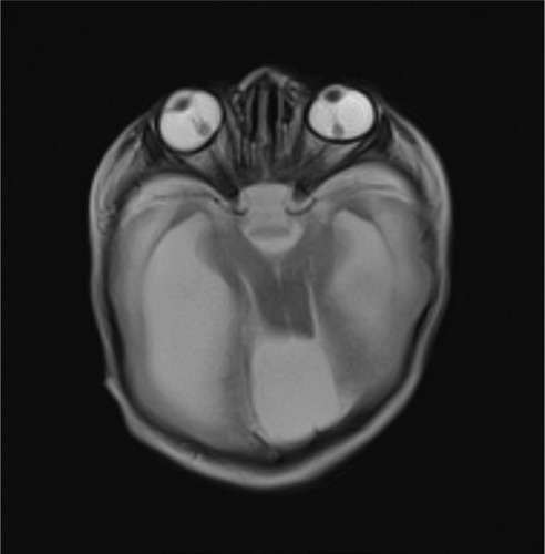 Figure 2 Axial T2-weighted image showing bilateral retinal detachment.