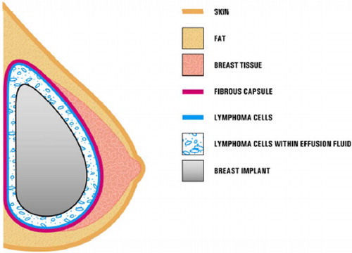 Figure 1. Presence of ALCL cells in close proximity to a breast implant. In most cases, the ALCL cells were found in the effusion fluid (seroma) surrounding the implant or contained within the fibrous capsule. (Reproduced from http://www.fda.gov/MedicalDevices/ProductsandMedicalProcedures/ImplantsandProsthetics/BreastImplants/ucm239995.htm).