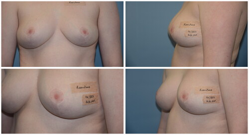 Figure 2. Patient 2, 16 months post bilateral reduction mammoplasty.