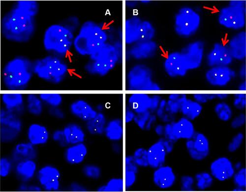 Figure 6 Fluorescence interphase in situ hybridization on lymph node biopsy. (A) IGH-BCL2 dual-colour dual-fusion probe displays two fused green and red signals, one isolated green and one isolated red signal in most of tumour nuclei with t(14;18) (q21;q32)/IGH-BCL2. Arrow indicates positive nuclei. (B) BCL2 dual-colour break-apart (BAP) probe shows one co-localised green and red signal, one isolated green and one isolated red signal in most of tumour nuclei; (C) BCL6 dual-colour break-apart (BAP) probe shows two co-localised green and red signal; (D) MYC dual-colour break-apart (BAP) probe shows one co-localised green and red signal.