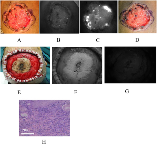 Figure 4 A female with squamous cell carcinoma of scalp, receiving preoperative and intraoperative ICG fluorescence imaging. (A) The gross appearance of the tumor; (B) Visible light image of the tumor under preoperative imaging; (C) Fluorescence image of the tumor under preoperative imaging; (D) Drawing the surgical margin based on the range of fluorescence; (E) The gross appearance of the wound after tumor resection; (F) Visible light image of the wound under intraoperative imaging; (G) Fluorescence image of the wound under intraoperative imaging; No residual fluorescence signal was found; (H) The HE staining of the resected tumor tissues. The scale bar indicates 200 μm.