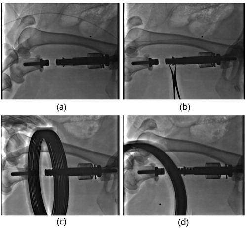 Figure 4. (a, b) Prespective images after implantation. (c, d) Prespective images of prosthesis extension.
