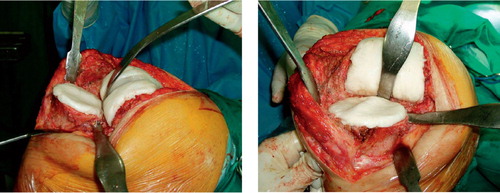 Figure 1. The grooves, the central crest on the tibial component, and the trochlear groove on the femoral component can be seen. This shape of the spacer increases conformity and reduces instability.