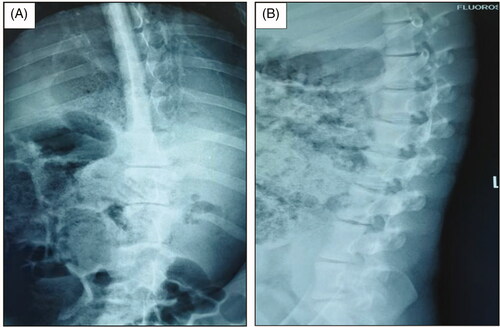 Figure 1. EOS in piglets induced by high-frequency electrotome at 3 months after the operation. Ablation power, 30 W; ablation time, 30 s; and spine segments ablated, 3. (A) Anteroposterior X-ray image of the spine. (B) Lateral X-ray image of the spine.