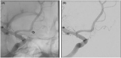 Figure 4. The ruptured aneurysm was treated using a single 2.5 mm × 3.5-cm 0.012″ PWD embolic coil, resulting in a packing density of 33.16% with complete aneurysm occlusion on digital subtraction angiography (A, unsubtracted image, oblique view; B, subtracted image, oblique view).