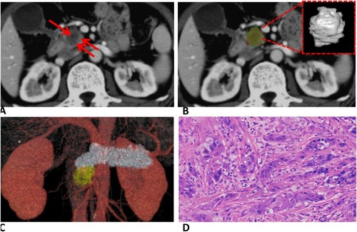 Figure 4 (A) Axial portal-phase contrast-enhanced CT image of high-grade PDAC in a 60-year-old man. Red arrows indicate the tumor. (B) Tumor segmentation. One observer segmented tumor in red and the other observer segmented tumor in green. The lime region indicates the overlapping region of two lesion masks. Segmentation shown by dashed red line. (C) Image reconstructed by AW VolumeShare 5. (D) HE-stained specimen (200×) demonstrated poor gland formation, tumor-cells nuclei were obviously pleomorphic with large nucleoli and common nuclear division.