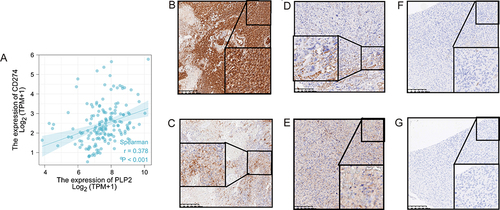 Figure 6 Correlation between PLP2 and PDL1 expression. (A) The expression of PLP2 was significantly correlated with the PDL1. (B and C) PLP2 and PDL1 immunohistochemical positive. (D and E) PLP2 and PDL1 immunohistochemical half positive. (F and G) PLP2 and PDL1 immunohistochemical negative.