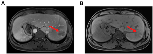 Figure 8 Magnetic resonance imaging showing a mass (red arrow) measuring 4.0×3.4 × 3.0 cm in segment VII and VIII of liver, (A) T1-weighted image; (B) T2-weighted image.