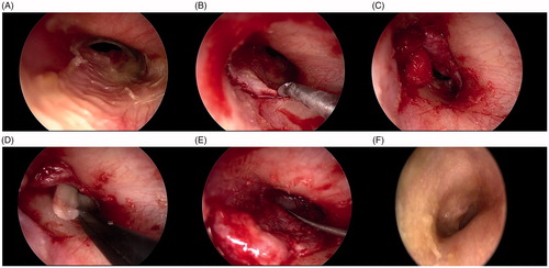 Figure 2. Endoscopic images of patient no: 3, right ear, (A) Anterior tympanic membrane perforation, (B) Tympanomeatal flap incision on posterior side can be seen on the posterior external auditory canal wall, (C) Posteriorly elevated tympanomeatal flap (D) Over-underlay cartilage graft placing, (E) Closure of tympanomeatal flap elevation, (F) Postoperative eight-month control.