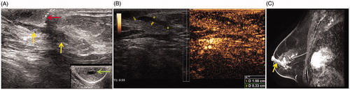 Figure 1. Imaging before microwave ablation (MWA) in a 63-year-old woman with left central intraductal papilloma (IDP). (A) Ultrasound (US) scan before MWA shows the dilated duct with hypoechoic IDP (yellow arrow) connected to the nipple (red arrow). The dilated duct is in the middle of nipple (green arrow). (B) Contrast-enhanced US before MWA shows both the dilated duct and lesion hypo-enhancement with a size 2.0 × 0.3 × 0.4 cm. (C) Sagittal contrast-enhanced magnetic resonance imaging (MRI) shows hyperintense duct (arrow) in the left breast before MWA in the arterial phase.