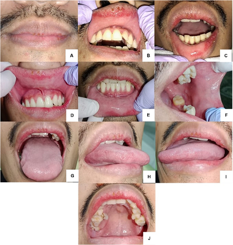 Figure 1 Clinical features of the patient’s lips and oral cavity at the initial visit (A–J).