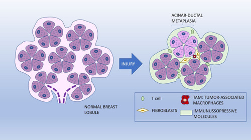 Figure 11 Schematic illustration of acinar-ductal metaplasia (ADM).