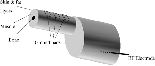 Figure 5. 3-D model of simplified human thigh, attached to torso. Three ground pads (5 × 5 cm, 1 cm apart) are placed on the thigh (20 cm diameter, with 5 cm diameter bone, 2 mm skin layer, and 13 mm fat layer). The ground pads are simulated as a 1 mm thick gel layer (not shown here).