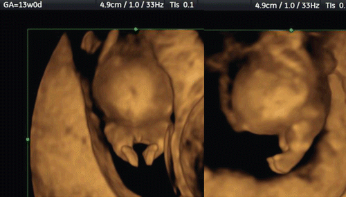 Figure 42.  Short limb abnormality at 13 weeks of gestation. Short lower extremities with large abdomen is clearly demonstrated in the frontal (left) and lateral (right) views.
