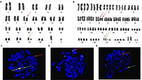 Figure 2 Karyotype and FISH analysis (Case 7).Notes: Numbers 1–22 represent chromosomes. (A) Karyotype of diploidy (R-banding): 46, XY, t (8;21)(q22;q22). 8q-(red arrow) and 21q+ (green arrow). (B) Karyotype of tetraploidy (R-banding): 92, XXYY, t(8;21)(q22;q22)×2. 8q-(red arrow) and 21q+ (green arrow). (C) FISH analysis with GLP RUNX1–RUNX1T1 dual color fusion probe (located at 21q22/8q22). Revealing 2F4O4G signals. Two fusions on the end of 21q+, four red signals (red arrow) are on native chromosome 8 and 8q−, two green signals proximal to the centromere of 21q+ (yellow arrow), and two native chromosome 21 (green arrow). (D) FISH analysis with GLP C-MYC dual color break-apart probe (located at 8q24); the picture displays that 8q24 (MYC) (red arrow) had not moved to 21q+. (E) FISH analysis with GLP ETV6–RUNX1 dual color fusion probe (located at 12p13/21q22). Tetraploidy metaphase shows red signals (red arrow) on chromosome 12, and six green signals (green arrow) consist of two on native chromosome 21 and four on 21q+×2. Magnification ×1000.Abbreviation: FISH, fluorescence in situ hybridization.