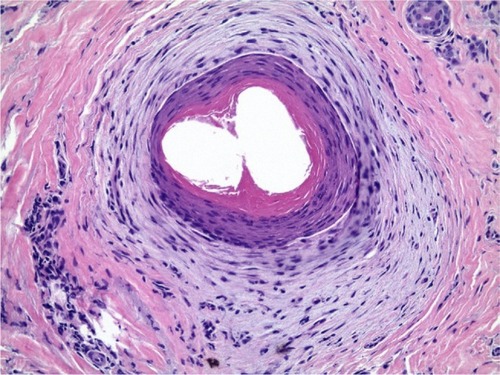Figure 4 Compound follicular structure “goggle” is formed by the fused outer root sheaths of two follicles emerging from the same ostium and surrounded by fibrosis.