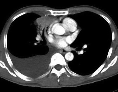 Figure 1.  Computed Tomography of the thorax showing a right middle lobe mass with a moderate right pleural effusion (at diagnosis).